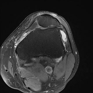 File:Central osteophyte (Radiopaedia 72592-83151 Axial PD fat sat 9).jpg