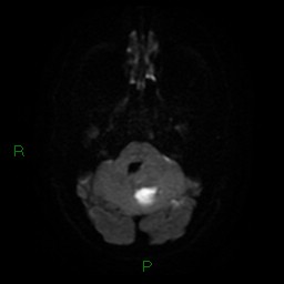 Cerebellar abscess (Radiopaedia 78135-90678 Axial DWI 9).jpg