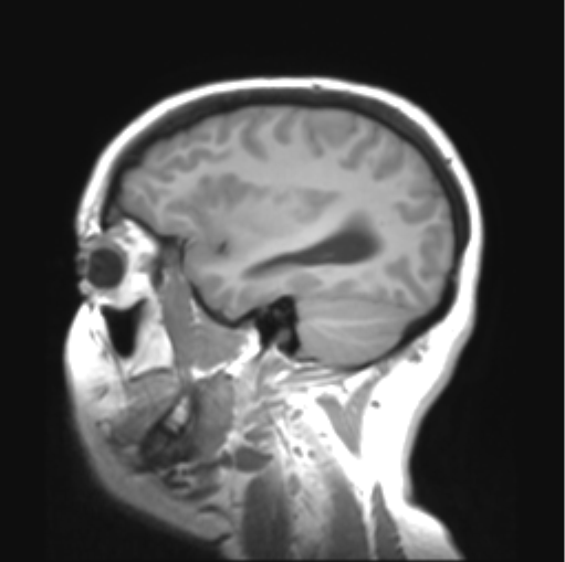 File:Cerebellar ependymoma complicated by post-operative subdural hematoma (Radiopaedia 83322-97736 Sagittal T1 11).png