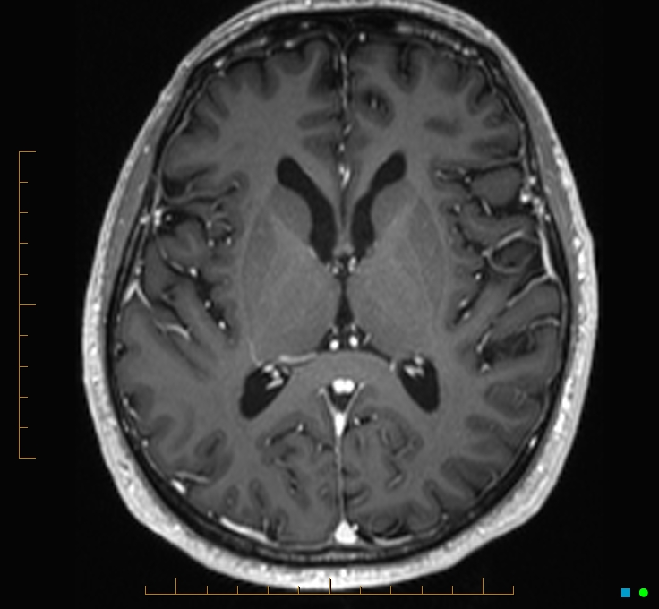 Cerebellar gangliocytoma (Radiopaedia 65377-74422 Axial T1 C+ 69).jpg