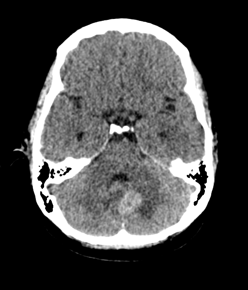Cerebellar metastases - colorectal adenocarcinoma (Radiopaedia 40947-43652 Axial non-contrast 19).png