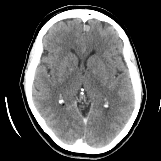 File:Cerebellar metastasis (cystic appearance) (Radiopaedia 41395-44258 B 25).png
