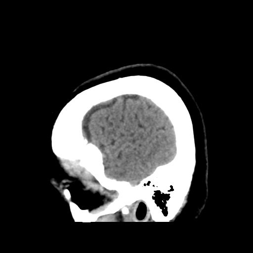 File:Cerebellar metastasis (cystic appearance) (Radiopaedia 41395-44258 E 11).png