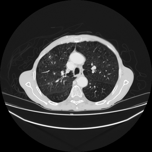File:Cerebellar metastasis - lung tumor (Radiopaedia 69317-79150 Axial lung window 12).jpg