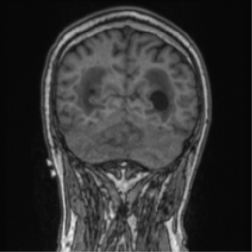 Cerebellar metastasis from lung adenocarcinoma (Radiopaedia 86690-102829 Coronal T1 27).png