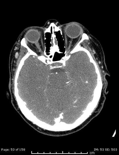Cerebellar strokes due to intracranial giant cell arteritis (Radiopaedia 68799-78510 CT angiogram 53).jpg