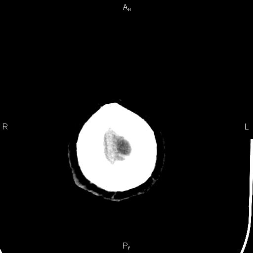 File:Cerebellopontine angle arachnoid cyst (Radiopaedia 85149-100704 Axial With contrast 53).jpg