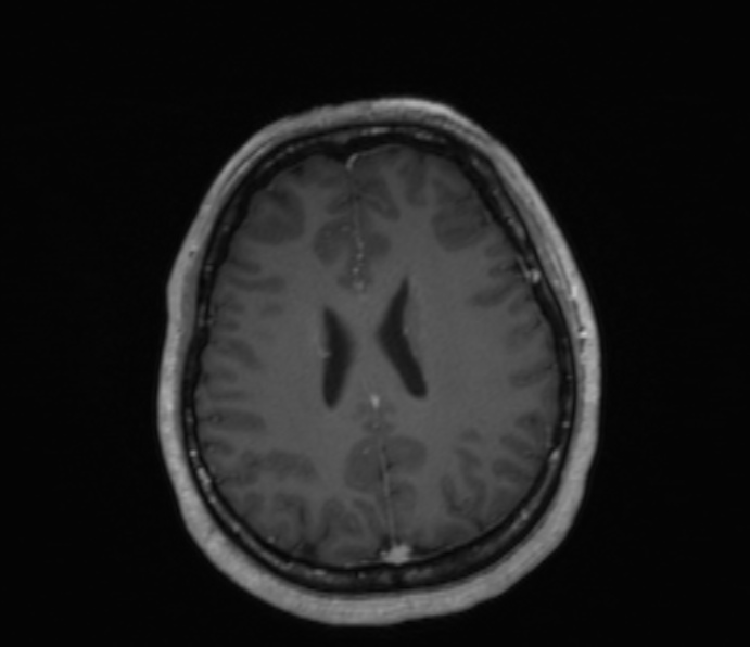 Cerebellopontine angle meningioma (Radiopaedia 35181-36715 Axial T1 C+ 21).jpg