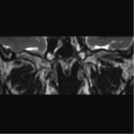 Cerebellopontine angle meningioma (Radiopaedia 48434-53348 Coronal T2 86).png