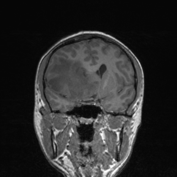 Cerebral abscess (Radiopaedia 24212-24478 Coronal T1 92).jpg
