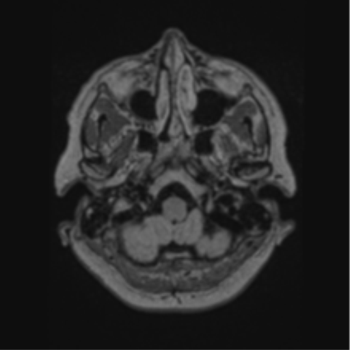 File:Cerebral abscess from pulmonary arteriovenous malformation (Radiopaedia 86275-102291 J 14).png
