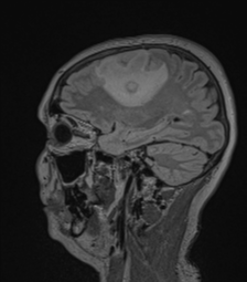 Cerebral abscess from pulmonary arteriovenous malformation (Radiopaedia 86275-102291 Sagittal FLAIR 50).png