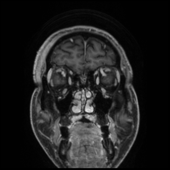 Cerebral abscess with ventriculitis (Radiopaedia 78965-91878 Coronal T1 C+ 13).jpg