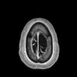 Cerebral amyloid angiopathy (Radiopaedia 29129-29518 Axial T1 C+ 141).jpg