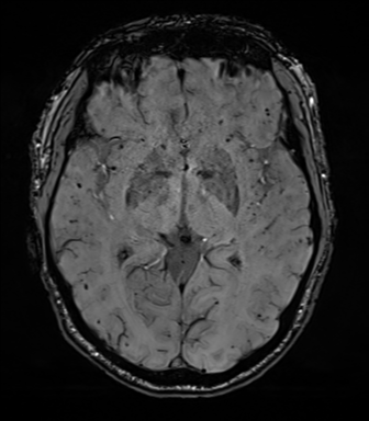 File:Cerebral amyloid angiopathy (Radiopaedia 46082-50433 Axial SWI 39).png