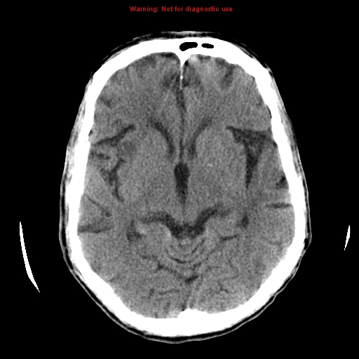File:Cerebral and orbital tuberculomas (Radiopaedia 13308-13310 Axial non-contrast 32).jpg