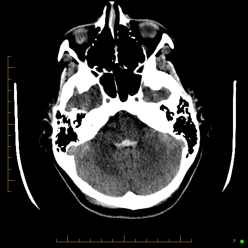 Cerebral arteriovenous malformation (AVM) (Radiopaedia 78162-90706 Axial non-contrast 17).jpg