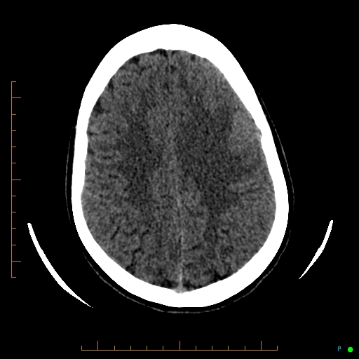 Cerebral arteriovenous malformation (AVM) (Radiopaedia 78162-90706 Axial non-contrast 47).jpg