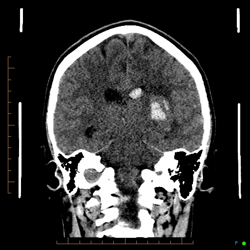 File:Cerebral arteriovenous malformation (AVM) (Radiopaedia 78162-90706 Coronal non-contrast 59).jpg
