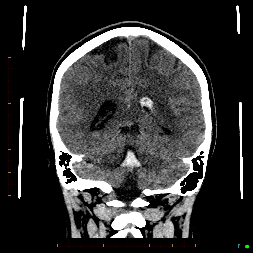 Cerebral arteriovenous malformation (AVM) (Radiopaedia 78162-90706 Coronal non-contrast 66).jpg