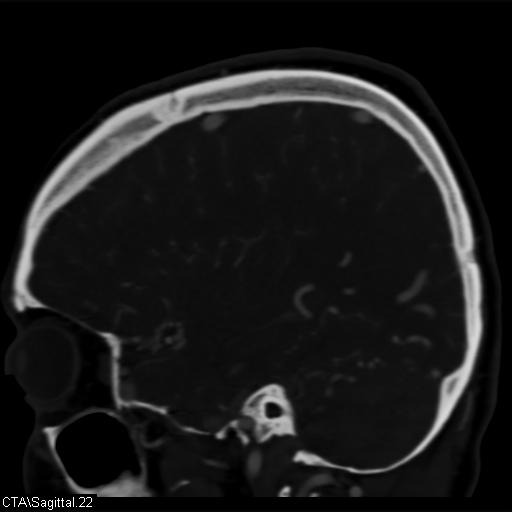 Cerebral arteriovenous malformation (Radiopaedia 28518-28759 D 19).jpg