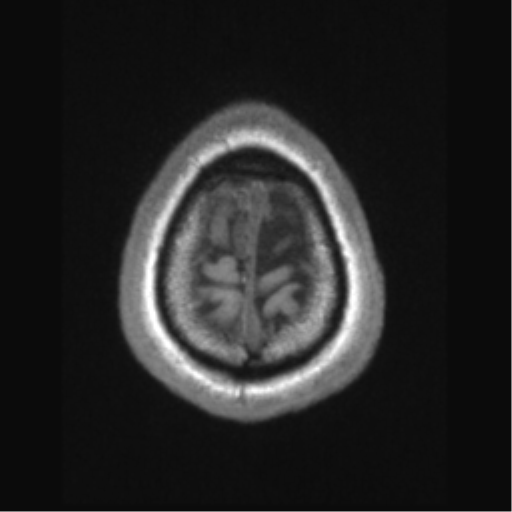 Cerebral arteriovenous malformation (Radiopaedia 39259-41506 Axial T1 73).png