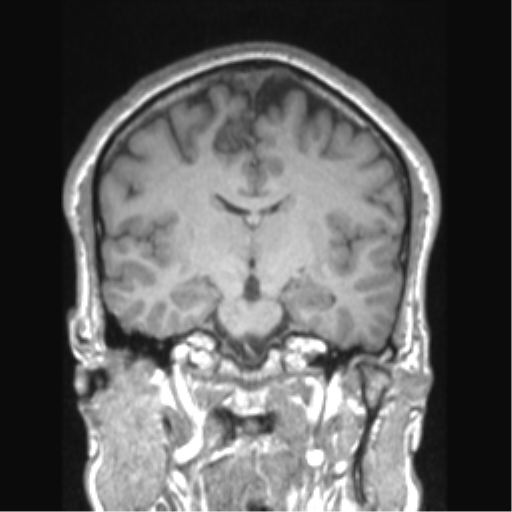 Cerebral arteriovenous malformation (Radiopaedia 39259-41506 Coronal T1 48).png
