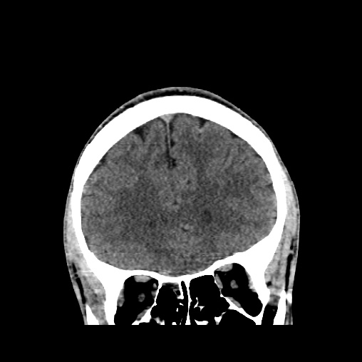 Cerebral arteriovenous malformation (Radiopaedia 61964-70028 Coronal non-contrast 17).jpg