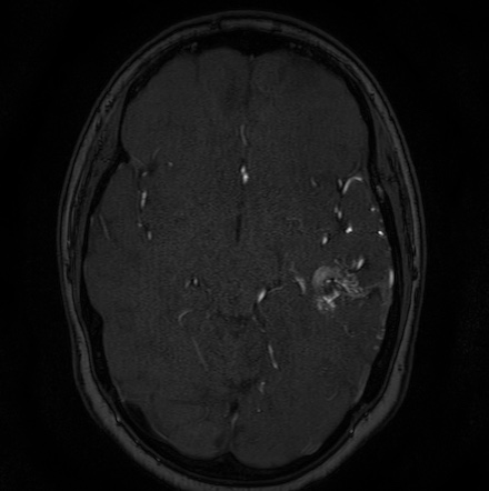 Cerebral arteriovenous malformation (Radiopaedia 74411-85654 Axial MRA 59).jpg