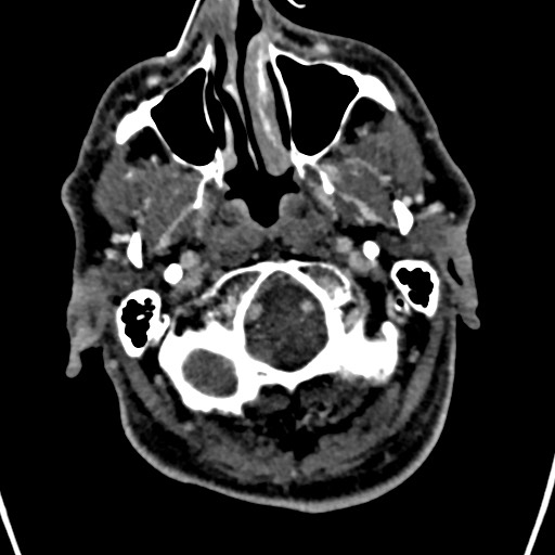 Cerebral arteriovenous malformation (Radiopaedia 78188-90746 Axial C+ delayed 15).jpg