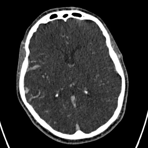 Cerebral arteriovenous malformation (Radiopaedia 78188-90746 Axial C+ delayed 92).jpg