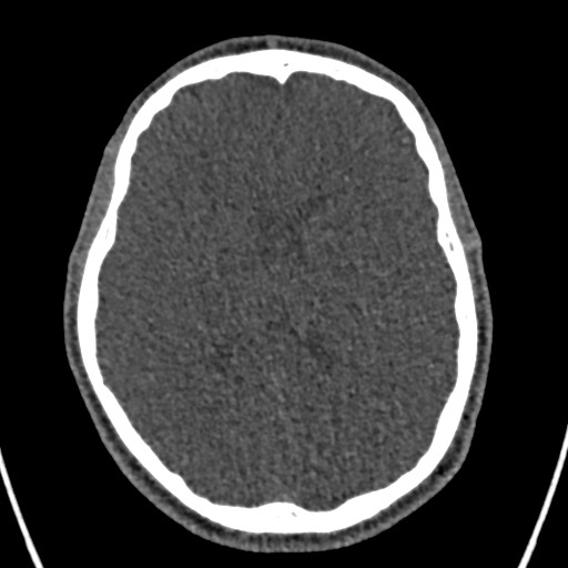 Cerebral arteriovenous malformation (Radiopaedia 78188-90746 Axial non-contrast 103).jpg