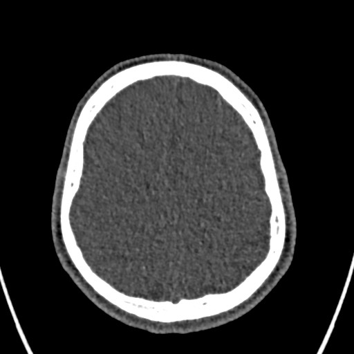 Cerebral arteriovenous malformation (Radiopaedia 78188-90746 Axial non-contrast 139).jpg