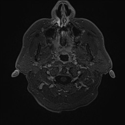 Cerebral arteriovenous malformation (Radiopaedia 84015-99245 Axial T1 C+ 6).jpg