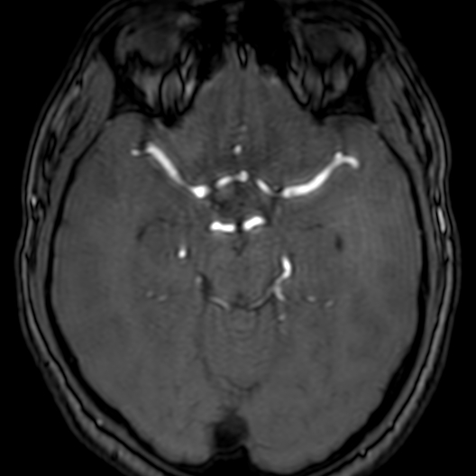 Cerebral arteriovenous malformation at posterior body of corpus callosum (Radiopaedia 74111-84925 Axial MRA 80).jpg