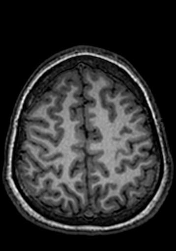 Cerebral arteriovenous malformation at posterior body of corpus callosum (Radiopaedia 74111-84925 Axial T1 56).jpg