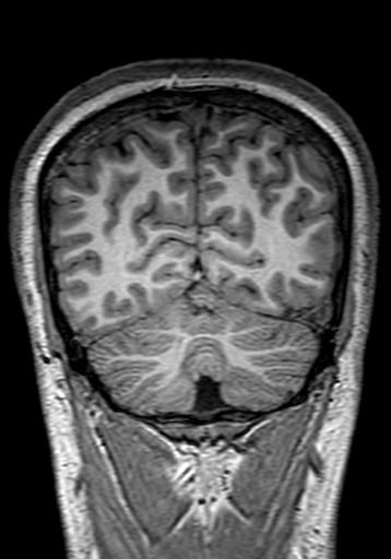 Cerebral arteriovenous malformation at posterior body of corpus callosum (Radiopaedia 74111-84925 Coronal T1 281).jpg