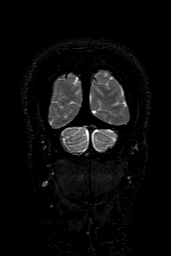 Cerebral arteriovenous malformation at posterior body of corpus callosum (Radiopaedia 74111-84925 Coronal T2 167).jpg