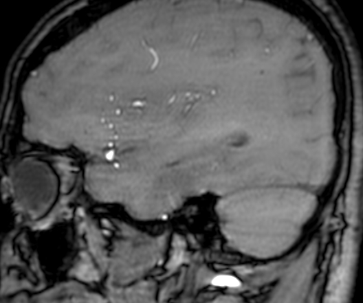 File:Cerebral arteriovenous malformation at posterior body of corpus callosum (Radiopaedia 74111-84925 J 88).jpg