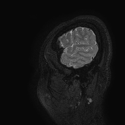 Cerebral arteriovenous malformation at posterior body of corpus callosum (Radiopaedia 74111-84925 Sagittal T2 1).jpg