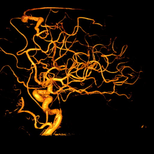 Cerebral arteriovenous malformation with lobar hemorrhage (Radiopaedia 44725-48513 Lateral 28).png