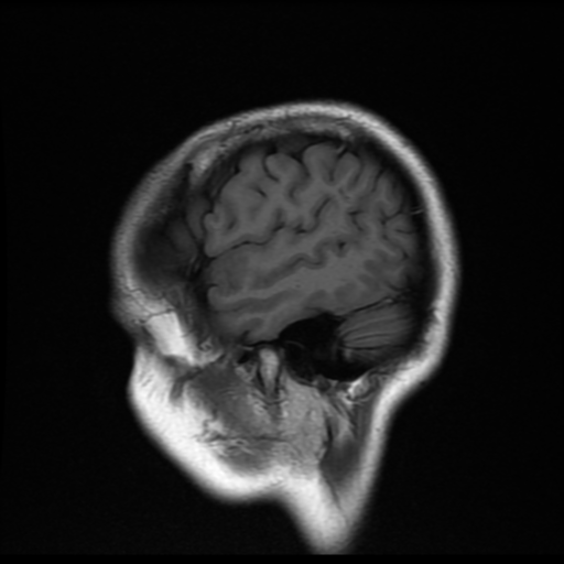 File:Cerebral autosomal dominant arteriopathy with subcortical infarcts and leukoencephalopathy (CADASIL) (Radiopaedia 41018-43768 Sagittal T1 3).png