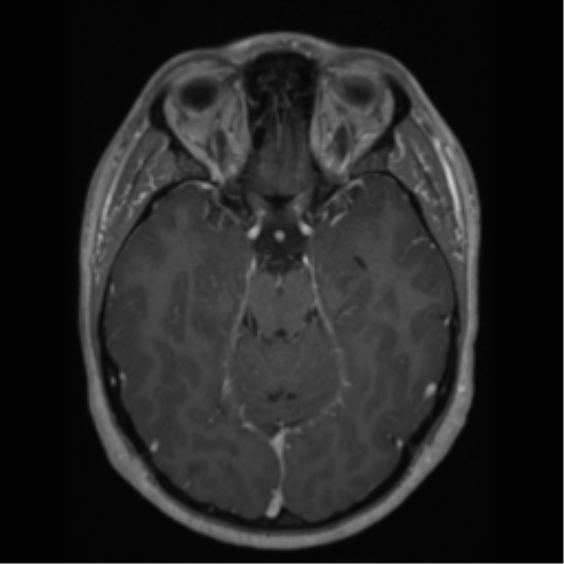 Cerebral cavernoma and development venous anomaly (Radiopaedia 37603-39482 Axial T1 C+ 29).png