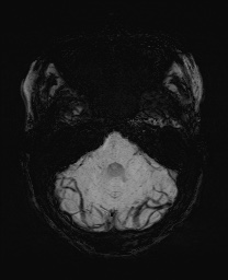 Cerebral cavernous venous malformation (Radiopaedia 70008-80021 Axial SWI 15).jpg