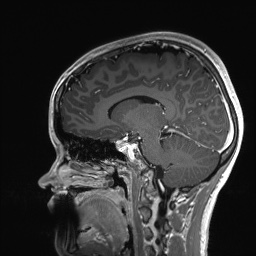 Cerebral cavernous venous malformation (Radiopaedia 70008-80021 Sagittal T1 C+ 41).jpg
