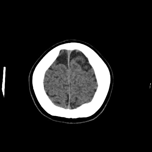 Cerebral cavernous venous malformation (Radiopaedia 70008-80022 Axial non-contrast 49).jpg