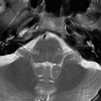 File:Cerebral cavernous venous malformation (Zabramski type II) (Radiopaedia 85511-101200 A 1).jpg