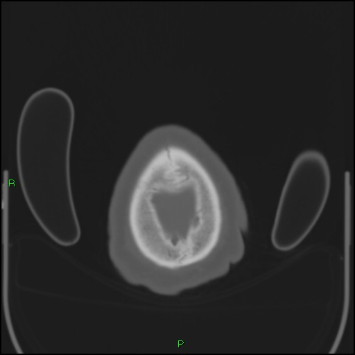 File:Cerebral contusions (Radiopaedia 33868-35039 Axial bone window 216).jpg
