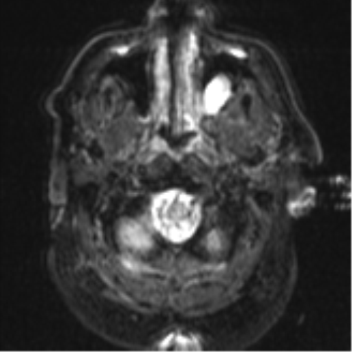 File:Cerebral embolic infarcts (embolic shower) (Radiopaedia 57395-64342 Axial DWI 3).png