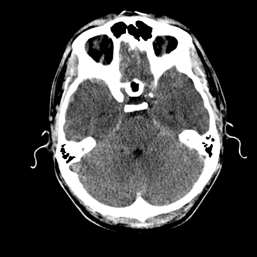 File:Cerebral hemorrhagic contusions- temporal evolution (Radiopaedia 40224-42753 Axial non-contrast 10).png